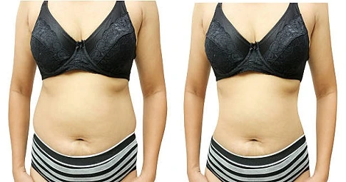 Fat Transfer Surgery before and after