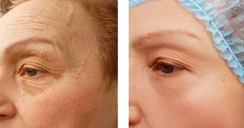 Hyaluronic injections before and after