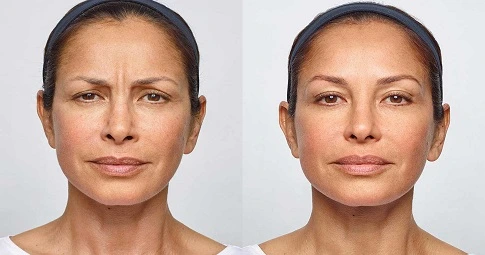 Hyaluronic injections before and after