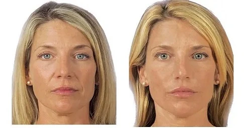Liquid Facelift before and after