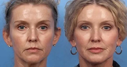 Liquid Facelift before and after