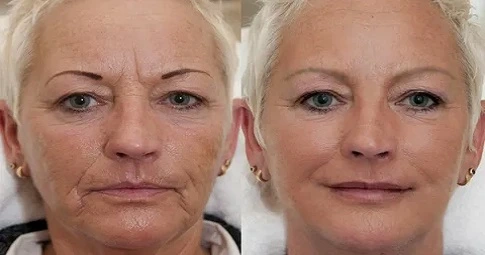 Liquid Facelift before and after