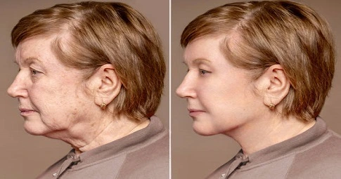 Magical Facelift in Dubai