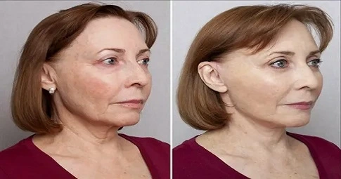 Magical Facelift in Dubai