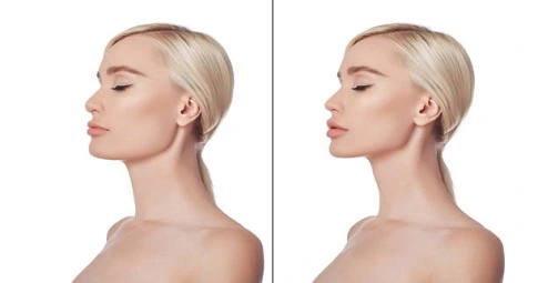 Nefertiti Lift Treatment before and after