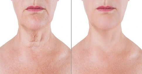 Nefertiti Lift Treatment before and after