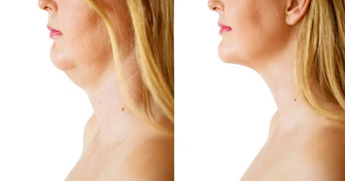 Nefertiti Lift Treatment before and after