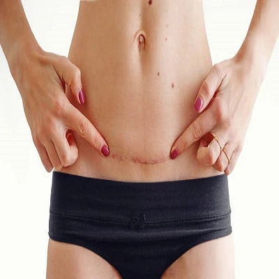 Surgical Scar Revision in Dubai
