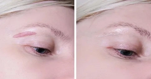 Surgical Scar Revision in Dubai