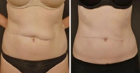 Surgical Scar Revision in Dubai
