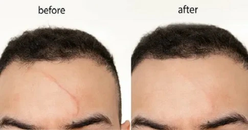 Surgical Scar Revision in Dubai