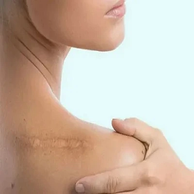 Surgical Scar Revision in Dubai