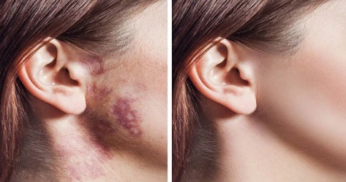 Surgical Scar Revision in Dubai
