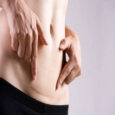 Surgical Scar Revision in Dubai