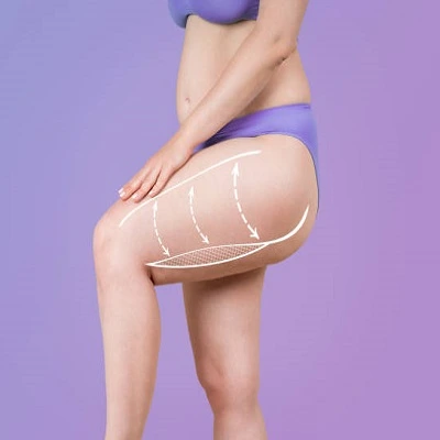 Thigh Lift in Dubai