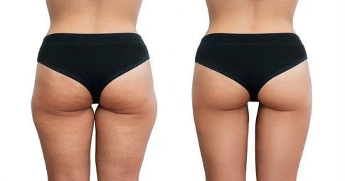 Thigh Lift before and after