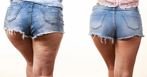 Thigh Lift before and after