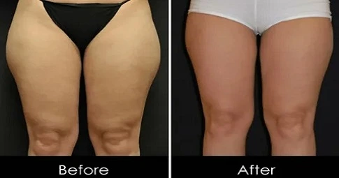 Thigh Lift before and after