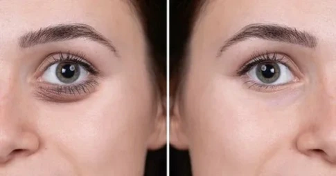Under Eye Filler Injections before and after