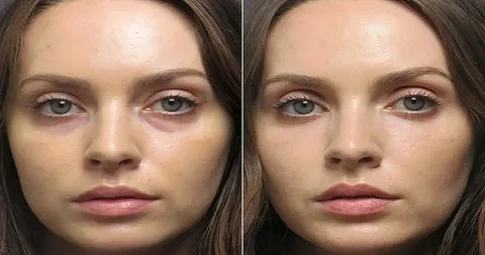 Under Eye Filler Injections before and after