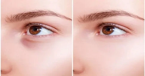 Under Eye Filler Injections before and after