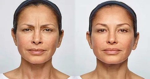 Wrinkle smoothing treatment before and after