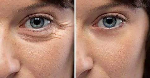 Wrinkle smoothing treatment before and after