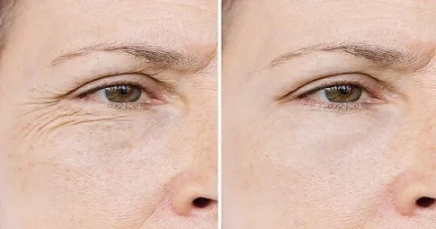 Wrinkle smoothing treatment before and after