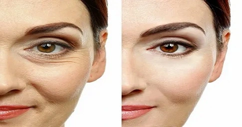 Wrinkle smoothing treatment before and after