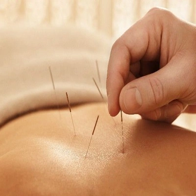 Acupuncture Treatment in Dubai & UAE