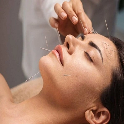 Acupuncture Treatment in Dubai & UAE