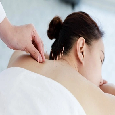 Acupuncture Treatment in Dubai & UAE