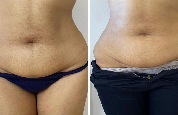 Aqualyx Injection before and after