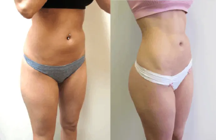 Aqualyx Injection before and after