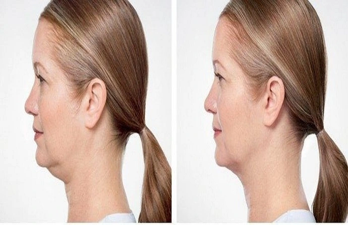 Aqualyx Injection before and after