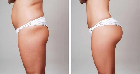 Body fillers - Buttock Implants before and after