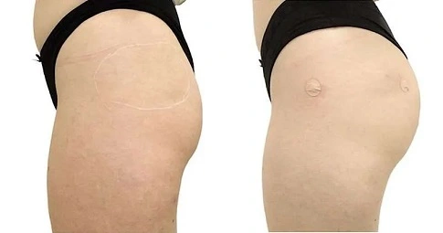Body fillers - Buttock Implants before and after