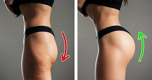 Body fillers - Buttock Implants before and after