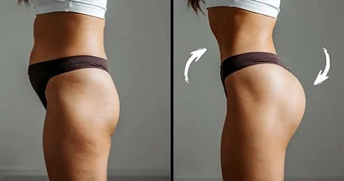 Body fillers - Buttock Implants before and after