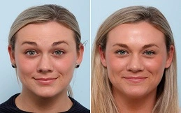 Cost of Botulinum Toxin Injections before and after