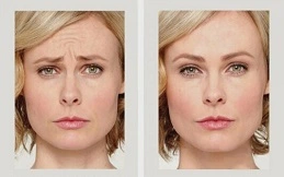 Cost of Botulinum Toxin Injections before and after