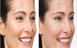 Cost of Botulinum Toxin Injections before and after