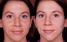 Carbon Laser Peeling to Treat Pigmentation