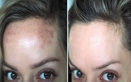 Carbon Laser Peeling to Treat Pigmentation