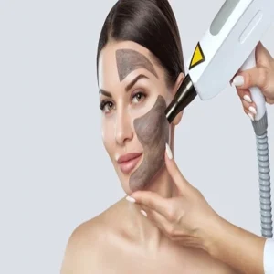 Carbon Laser Peeling to Treat Pigmentation