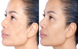 Carbon Laser Peeling to Treat Pigmentation