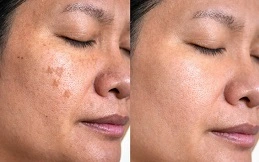 Chemical Peels for the Tretment of Melasma in Patient before and after