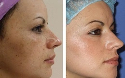 Chemical Peels for the Tretment of Melasma in Patient before and after