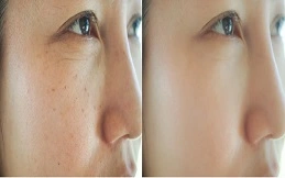 Chemical Peels for the Tretment of Melasma in Patient before and after