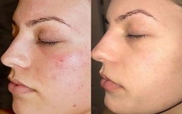 Chemical Peels for the Tretment of Melasma in Patient before and after
